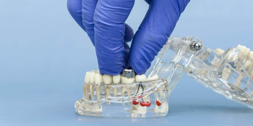 vidalı i̇mplant diş ve yapıştırma i̇mplant diş nedir?